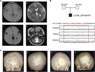 Case report: A novel truncating variant of BCL11B associated with rare feature of craniosynostosis and global developmental delay